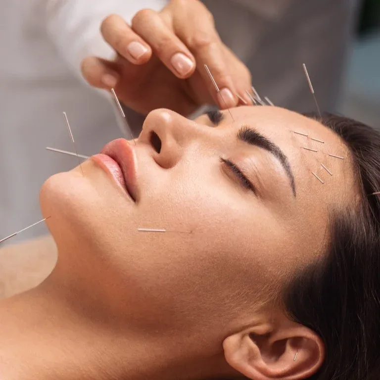 Acupuncture